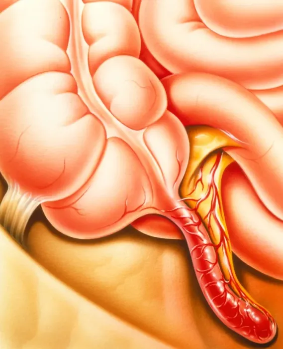 Framed Print : Appendix with inflamed appendix Print
