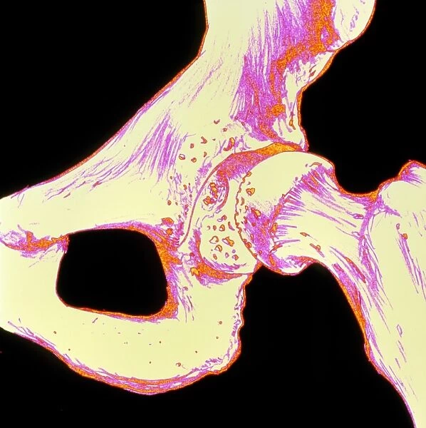 Artwork of hip joint in osteoporosis