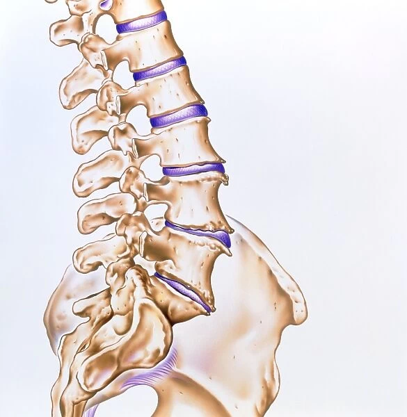 Artwork of osteoarthritis of the spine