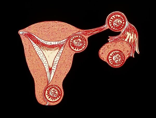 Artwork showing multiple ectopic pregnancies