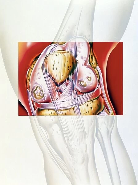 Artwork showing rheumatoid arthritis of the knee