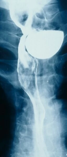 Bariium swallow x-ray showing weakness in muscle