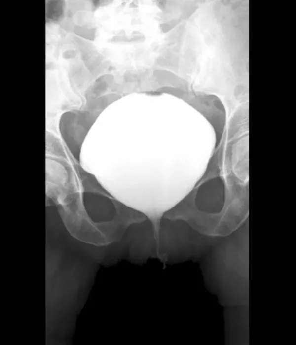 Framed Print : Full Bladder X-ray Cystography Print Framed Print : Full Bladder X-ray Cystography Print