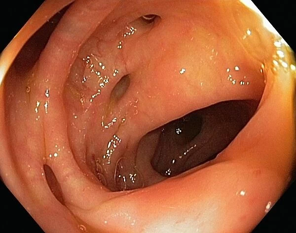 Bowel disease in the colon C016  /  8338