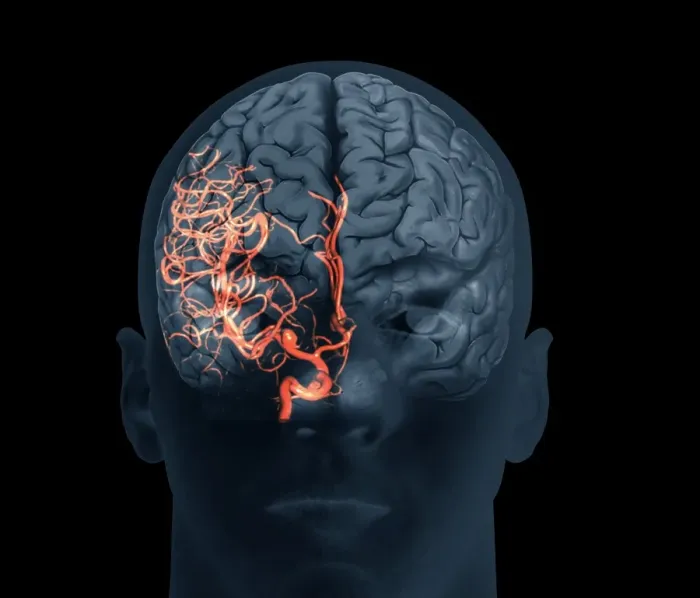 Framed Print : 3D CT Angiogram Print of a Brain Aneurysm Framed Print : 3D CT Angiogram Print of a Brain Aneurysm