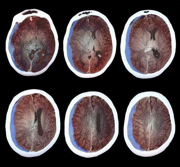 Brain haemorrhage, CT scans C018  /  0569