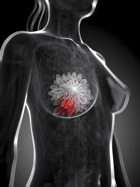 Breast cancer, artwork F005  /  0464