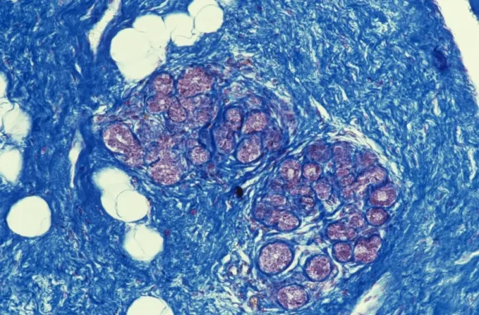 Framed Print : Breast Tissue Print, Light Micrograph Framed Print : Breast Tissue Print, Light Micrograph