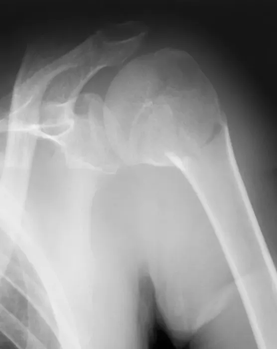 Framed Print : Print of X-ray showing a broken shoulder Framed Print : Print of X-ray showing a broken shoulder
