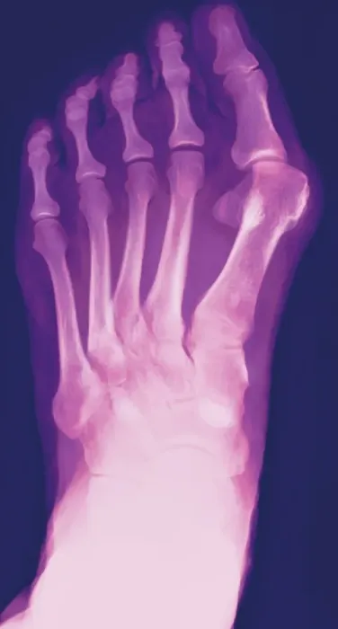 Framed Print : Colour X-ray Print of a Bunion Framed Print : Colour X-ray Print of a Bunion