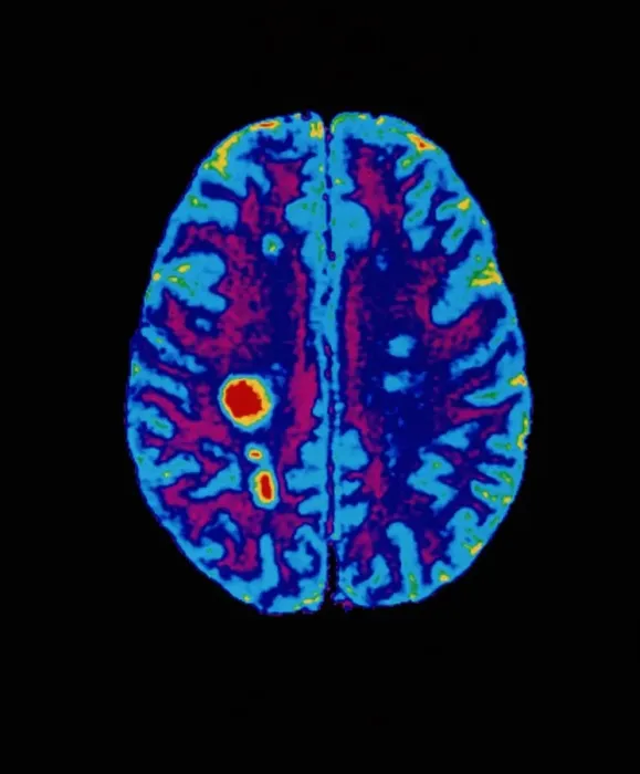 Framed Print : Multiple Sclerosis Brain MRI Scan Print Framed Print : Multiple Sclerosis Brain MRI Scan Print