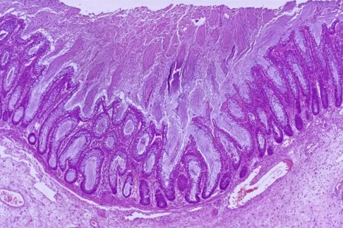 Framed Print : Pseudomembranous Colitis Print, x13 magnification Framed Print : Pseudomembranous Colitis Print, x13 magnification