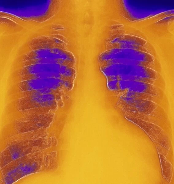 Coloured chest X-ray of ventricular cardiomyopathy