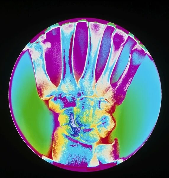 Coloured X-ray of bones in the wrist of the hand