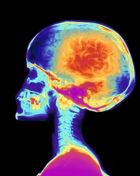 Coloured X-ray of human skull, brain superimposed