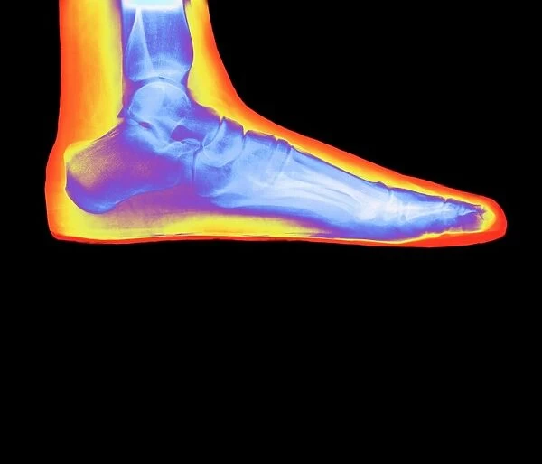 Coloured X-ray of a womans flat foot