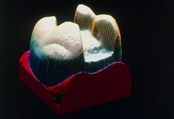 Computer graphic of a tooth ready for dental inlay