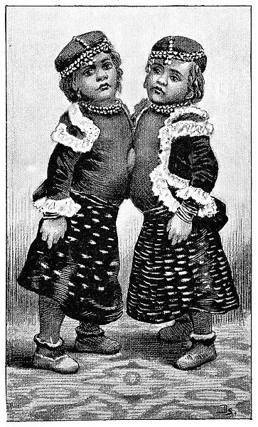Conjoined twins, 1893