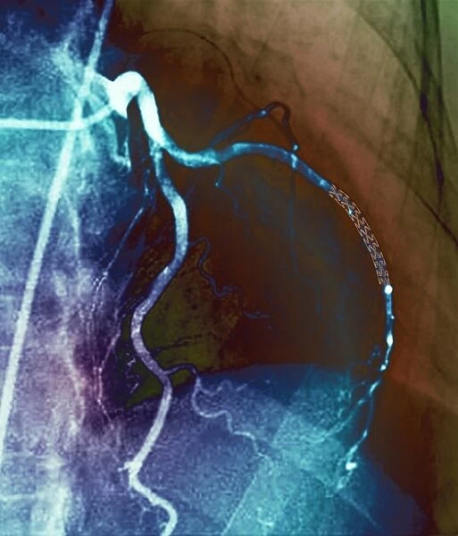 Coronary stent, X-ray F006  /  9141