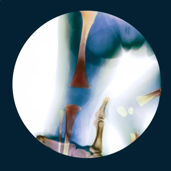 Framed Print : Corrected knee dislocation, X-ray Print Framed Print : Corrected knee dislocation, X-ray Print