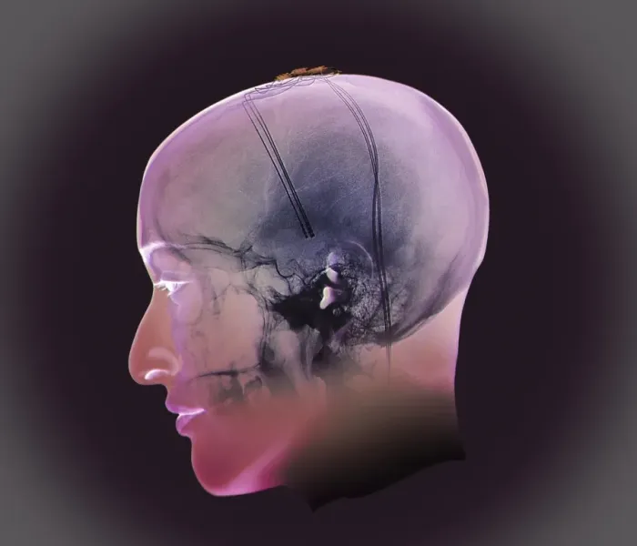 Framed Print : Deep Brain Stimulation Print: 3D Model of Electrode Placement Framed Print : Deep Brain Stimulation Print: 3D Model of Electrode Placement