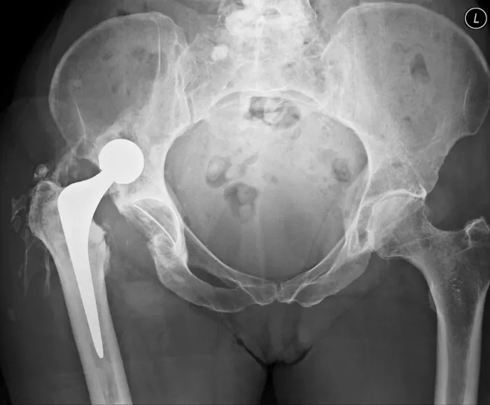 Framed Print : Dislocated Hip Replacement Print, X-ray Image Framed Print : Dislocated Hip Replacement Print, X-ray Image
