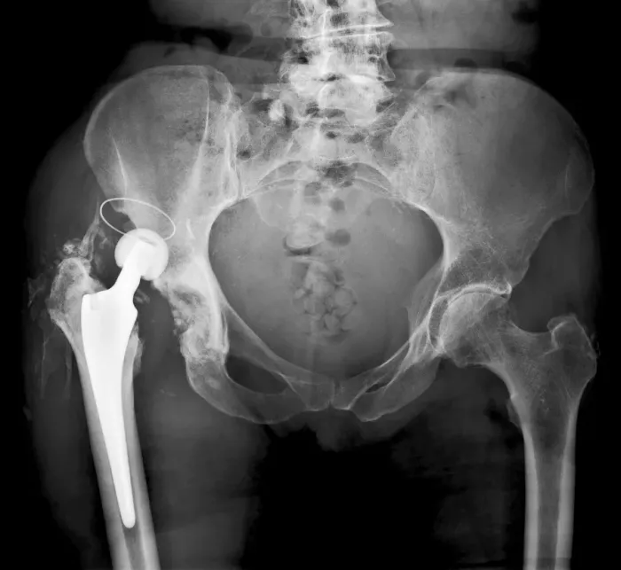 Framed Print : Dislocated Hip Replacement Print Framed Print : Dislocated Hip Replacement Print
