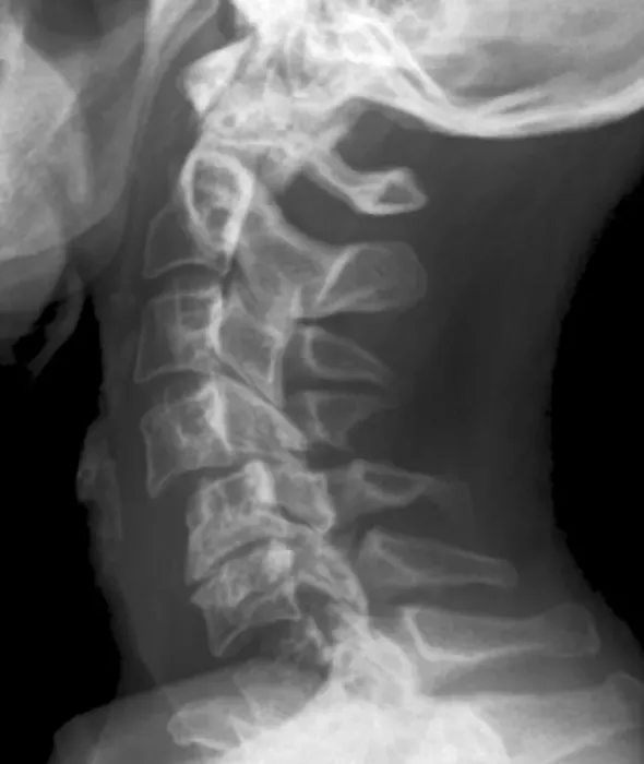 Framed Print : Dislocated Neck Bones Print: C5-C6 Vertebral Dislocation X-ray Framed Print : Dislocated Neck Bones Print: C5-C6 Vertebral Dislocation X-ray