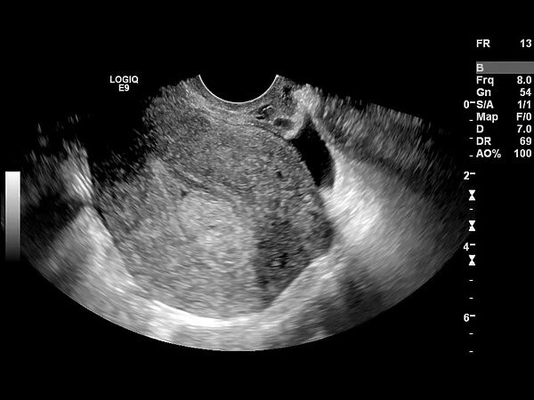 Endometrial polyp, ultrasound scan C017  /  7800