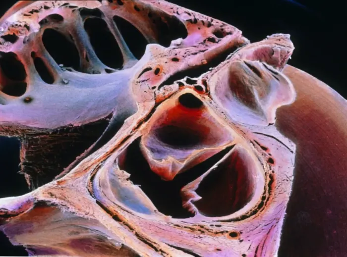 Framed Print : False-colour SEM Print of Aortic Valve Framed Print : False-colour SEM Print of Aortic Valve