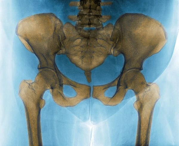 Female pelvis, X-ray