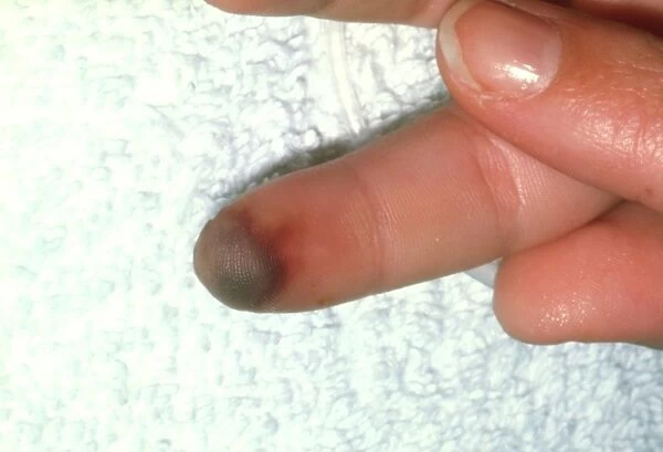 Finger of patient with peripheral vasoconstriction