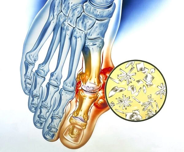 Gout. Artwork of the bones of a foot, showing a tophus (swelling) due to gout