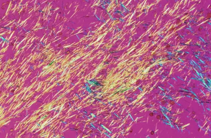 Framed Print : Gout Crystals Print, Polarised Light Micrograph Framed Print : Gout Crystals Print, Polarised Light Micrograph