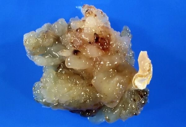 Gross specimen: atrial myxoma, benign heart tumour