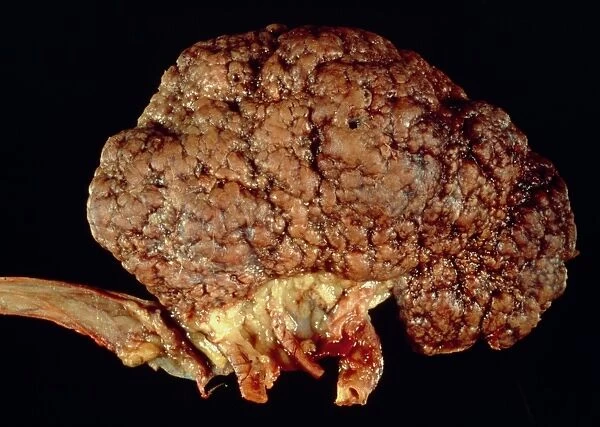 Gross specimen of kidney scarred by hypertension