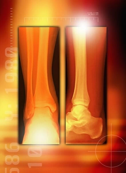 Healing ankle fracture, X-ray