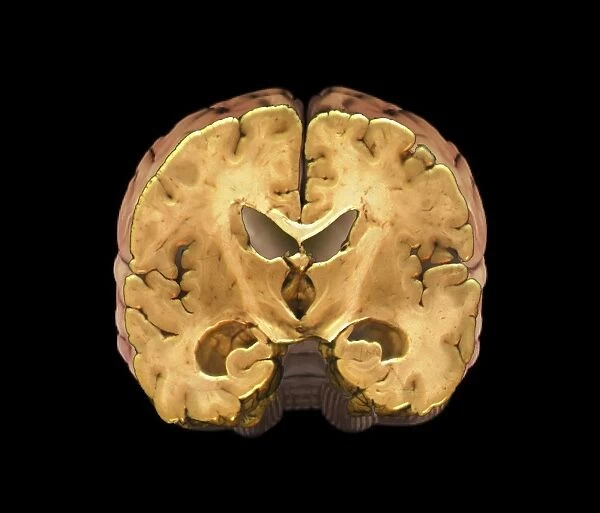 Healthy brain, MRI scan C018  /  0423