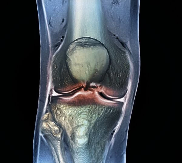 Healthy knee, CT scan C018  /  0415