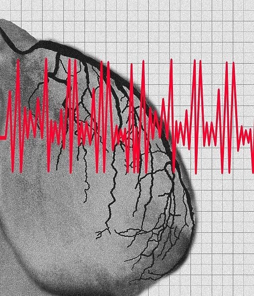 Heart attack: artwork of heart angiogram and ECG