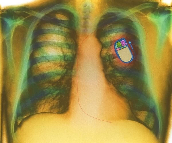 Heart pacemaker, X-ray
