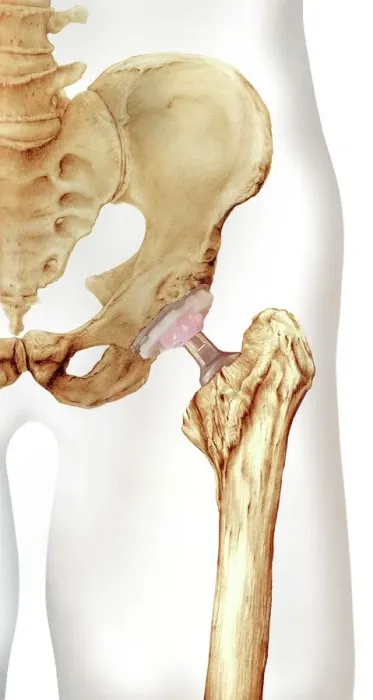 Framed Print : Hip Replacement Print: A Prosthetic Joint Framed Print : Hip Replacement Print: A Prosthetic Joint