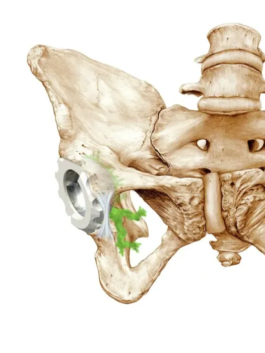 Framed Print : Hip Replacement Print: A prosthetic hip joint socket in a pelvis Framed Print : Hip Replacement Print: A prosthetic hip joint socket in a pelvis