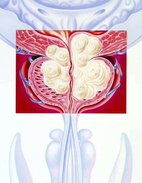 Framed Print : Benign Prostatic Hyperplasia Print Framed Print : Benign Prostatic Hyperplasia Print