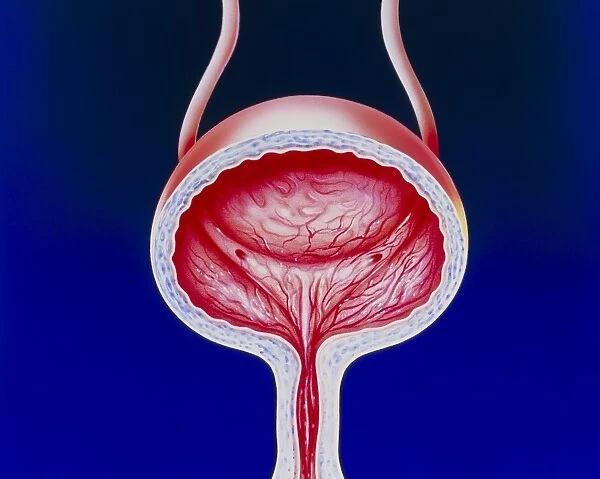 Illustration of a female bladder with cystitis