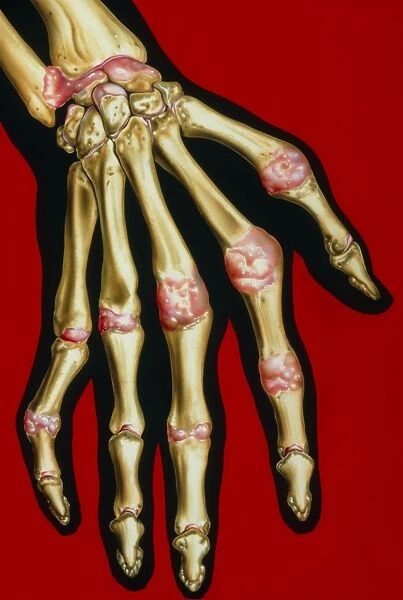 Illustration of rheumatoid arthritis in hand