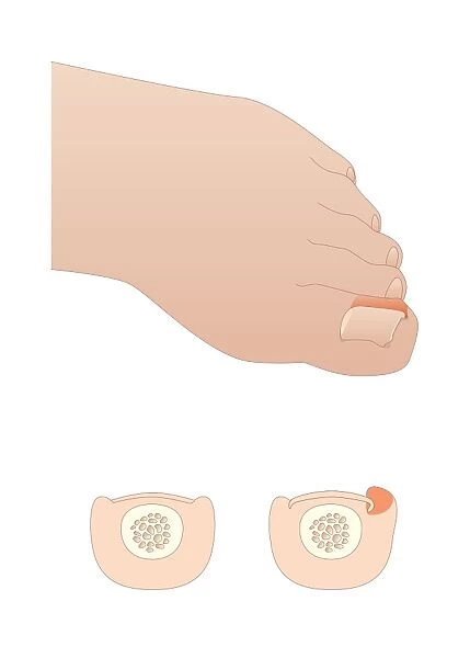 Ingrowing toenail, artwork