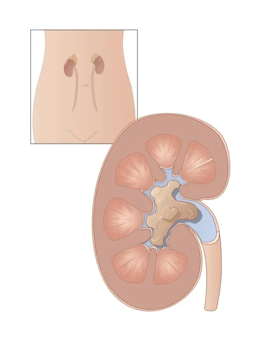 Framed Print : Large kidney stone print Framed Print : Large kidney stone print