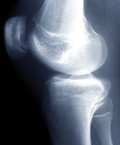 Knee disease, X-ray F006  /  9138