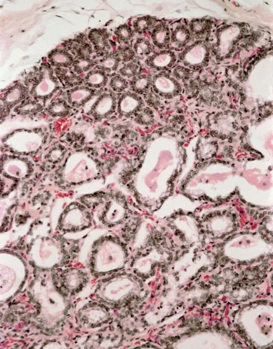 Framed Print : Lactating Breast Tissue Print Framed Print : Lactating Breast Tissue Print